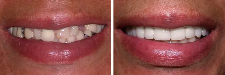 before and after Crown Bridge Implants