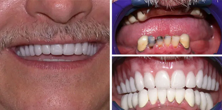 before and after Crown Bridge Implant Dentures