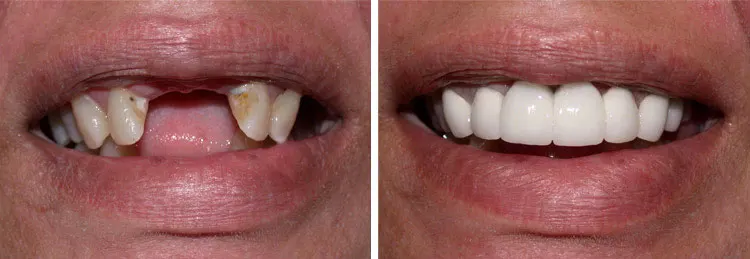 before and after Crown Bridge Implant