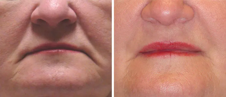 Before and After Botox patient