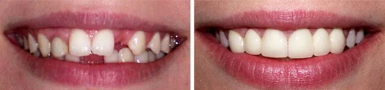Before and after Crown Bridge Implant