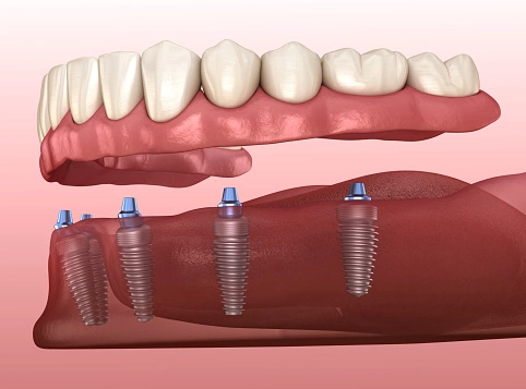 all on 4 dental implants being placed on lower jaw