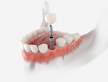 Dental Implant - tooth replacement options