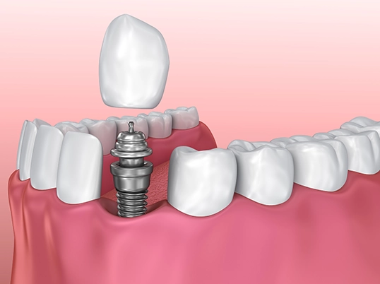 Single Tooth Implant In Mobile, AL