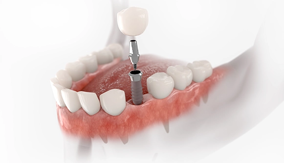 Insurance/Finance Options For Dental Implants