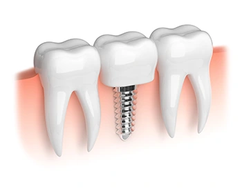 Average Life Expectancy of Dental Implants, Factors Impacting Lifespan of Dental Implants, Tips for Increasing the Lifespan of Dental Implants