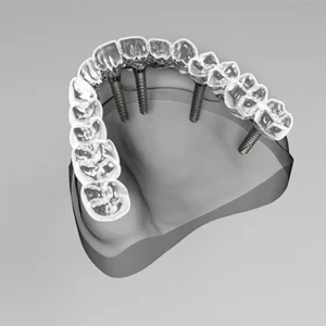 All-on-4-Dental Implants