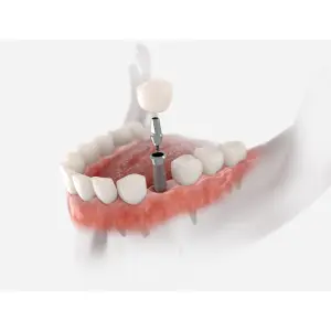 Dental Implants Last Longer