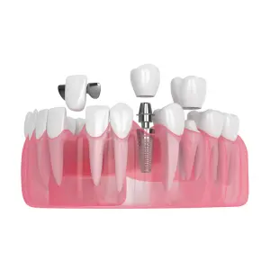 How successful are dental implants